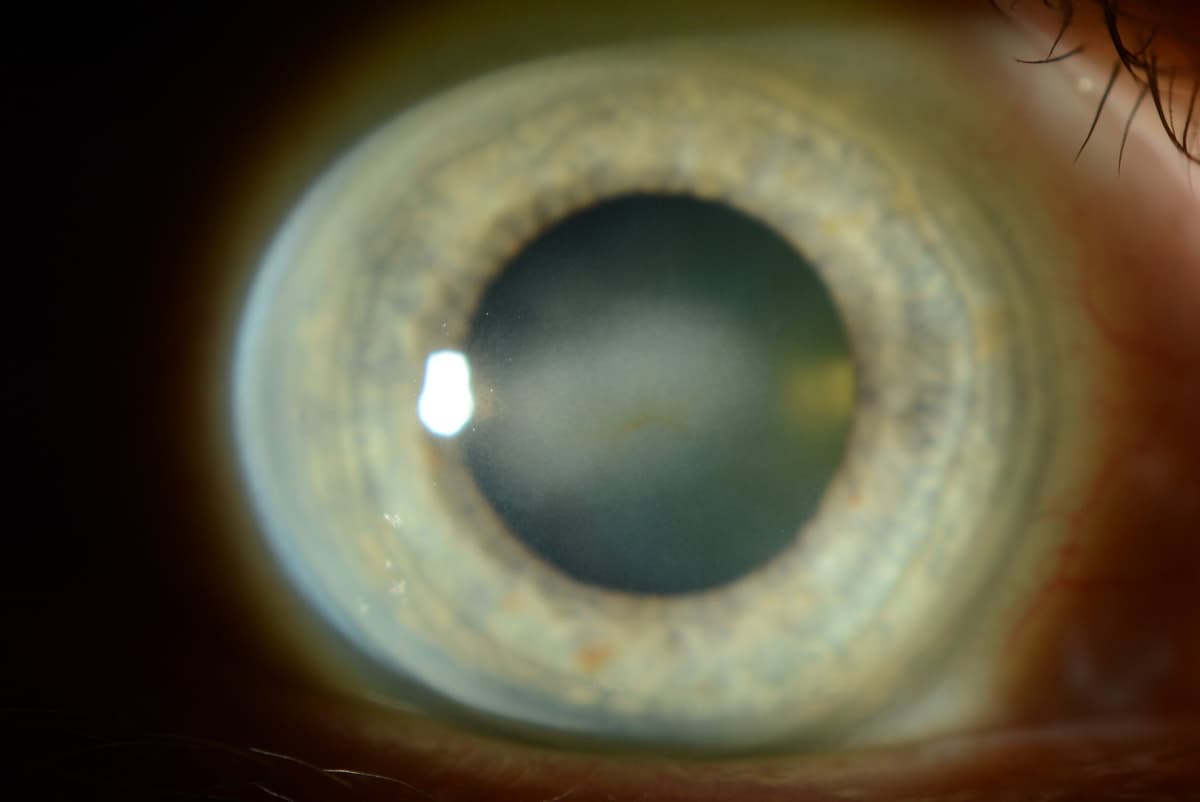 Close-up image of a human eye showing a cloudy area in the center of the cornea.